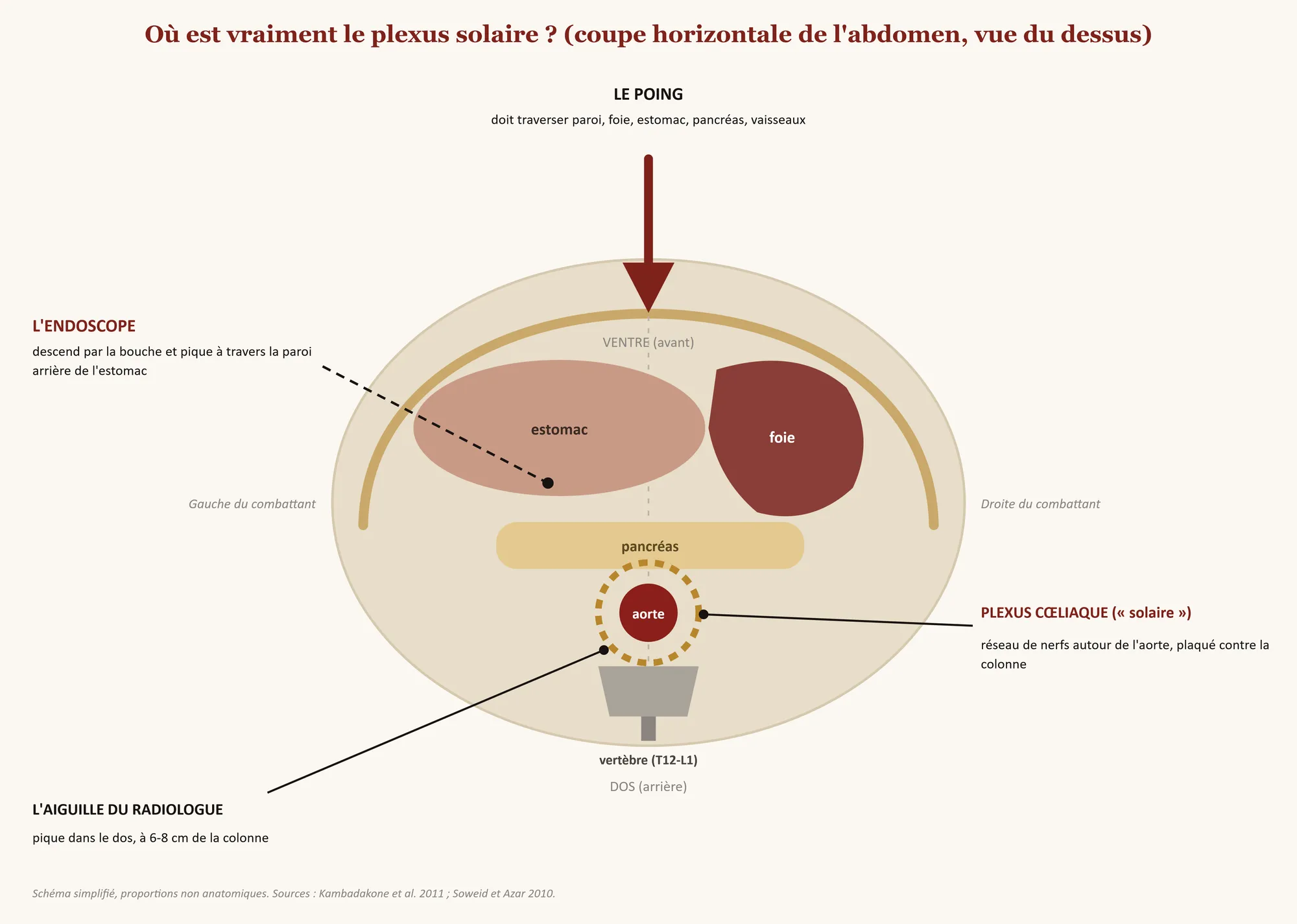 Coupe horizontale de l'abdomen vue du dessus : le poing arrive par l'avant et doit traverser la paroi, le foie, l'estomac, le pancréas et les vaisseaux avant d'atteindre le plexus cœliaque, placé autour de l'aorte contre la vertèbre. L'aiguille du radiologue passe par le dos, l'endoscope par la paroi arrière de l'estomac.